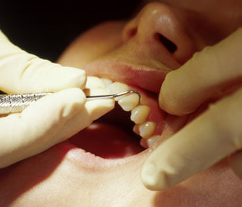 NEI certified dentist near Charlotte, NC discusses why mercury should not be used in dentistry