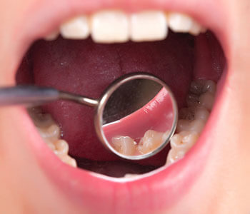Benefits of a Holistic Dentist