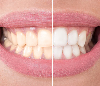 Cary area dentist reviews the best teeth whitening treatments for patients through a dental facility
