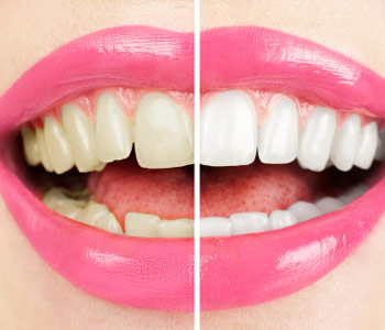 Cary patients ask about professional teeth whitening procedures
