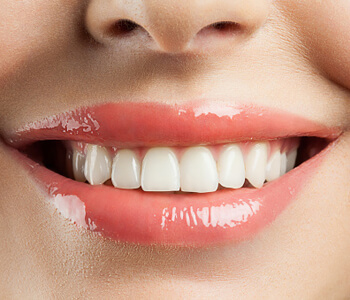 What sets professional teeth whitening apart from over-the-counter bleaching solutions available in the Raleigh area?