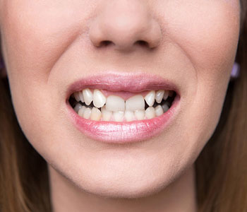 Beautiful Teeth With Veneers , Carl Mcmillan, Dmd, Pa