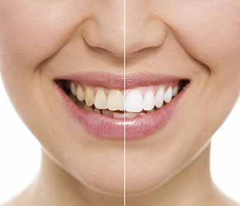 Cosmetic dental services are used to improve the teeth aesthetically.